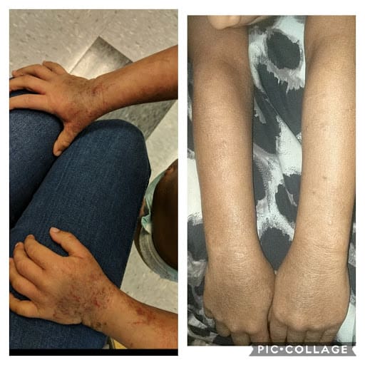 One year of healing childhood eczema, progress from functional nutrition and food sensitivity elimination diet